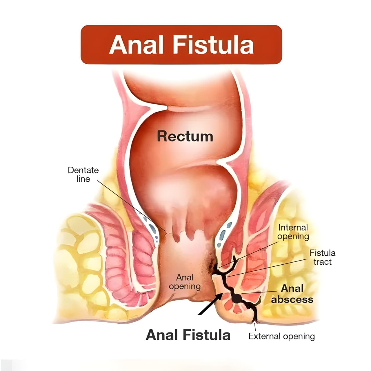 Fistula Surgery